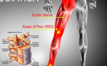 Headline: The Rising Economic Burden of Sciatica in Zimbabwe: A Silent Crisis Impacting Workforce Productivity